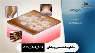 ویتیلیگو برص توضیحات آن بهاق لک و پیس