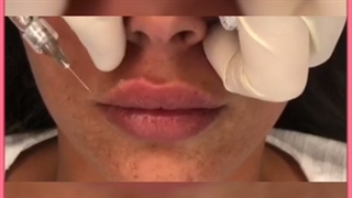 عوارض احتمالی تزریق ژل در نواحی مختلف صورت و بدن ترمیم لبخند لثه‌ای