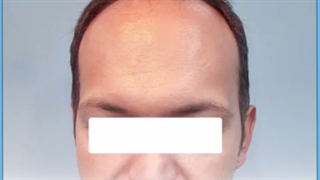 کاشت مو در جای زخم و بخیه با چه روشی امکان پذیر است؟