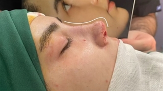 جراحی قوز بینی