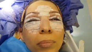 فیلم جراحی پلک و لیفت ابرو