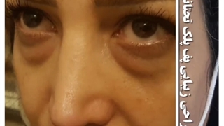 فیلم جراحی پلک پایین