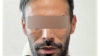 تزریق بوتاکس