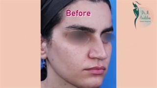 نمونه عمل زیبایی بینی