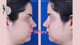 نمونه ای واقعی از فیلم اتاق عمل جراحی بینی گوشتی