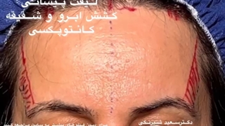 عمل لیفت شقیقه و پیشانی | دکتر سعید شیرنگی