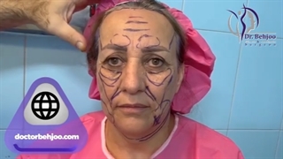 لیفت کامل صورت با کوتاه کردن پیشانی