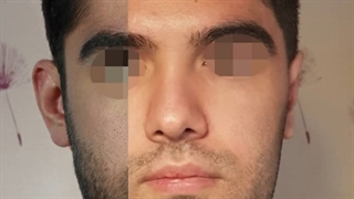 نتیجه دو ماه بعد از جراحی اتوپلاستی گوش