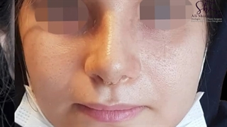 یکهفته پس از جراحی بینی