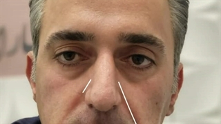 نمونه واقعی تزریق فیلر زیر چشم