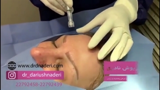 فیلم کامل میکرونیدلینگ
