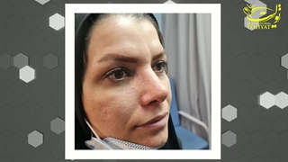 یک ماه بعد از عمل بینی| دکتر سید علیرضا تولیت