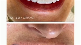 لامینیت ده دندان فک بالا با رنگ سفید صدفی