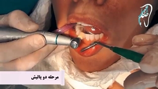 طبیعی بودن لمینت