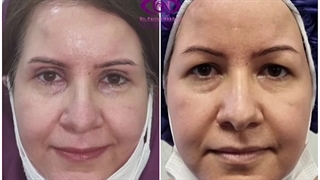 بلفاروپلاستی