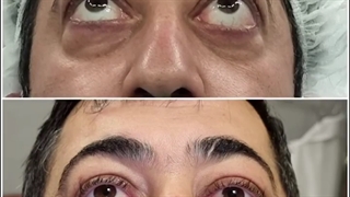 اصلاح بیرون زدگی چشم