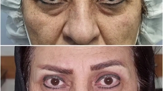 اصلاح افتادگی پلک