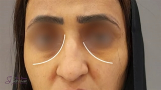 تزریق فیلر زیر چشم و خط خنده