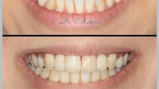 ارتودنسی با کشیدن دندان | دکتر احسان ابوئی مهریزی