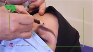 تزریق بوتاکس به پیشانی ترمیم زیبایی دندان