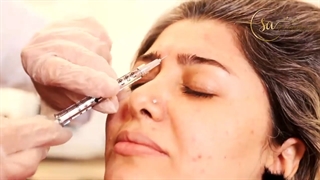 فیلم واقعی تزریق بوتاکس پیشانی️