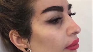 زاویه سازی صورت با تزریق چربی