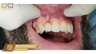 همیشه طرح درمان پیچیده و پرهزینه چاره کار نیست!! | کلینیک دندانپزشکی دکتر پورشاهی