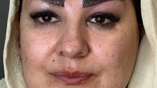 نمونه ای دیگر از کاشت ابرو