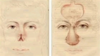 تاریخچه جراحی بینی