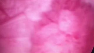 تومور مثانه و نمای بعداز عمل آن که تومور برداشته شده