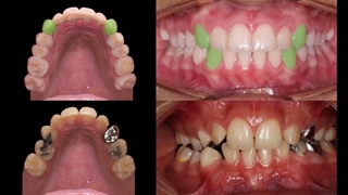 ارتودنسی نیش نهفته | دکتر داودیان