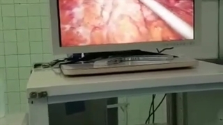 لاپاروسکوپی زخم معده پاره شده
