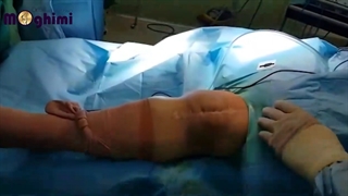 عمل رویژن توتال نی آرتروپلاستی یا تعویض مجدد مفصل زانو