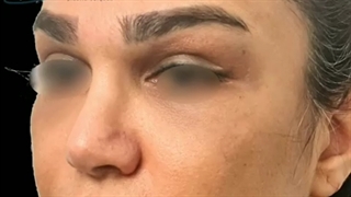 عمل لیفت اندوپکسی ابرو