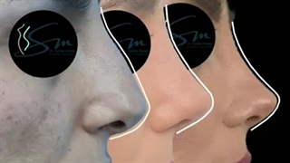 جراحی بینی بعد از سه ماه