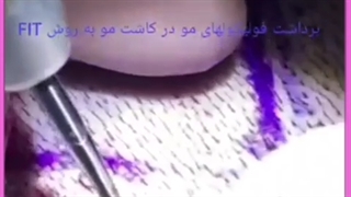 بانک مو و گرافت مو چیست ؟