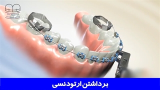 برداشتن ارتودنسی | دکتر احسان ابوئی مهریزی