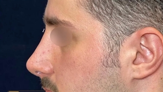 نمونه کار جراحی زیبایی بینی مردانه | دکتر شاهرخ خوش سیرت