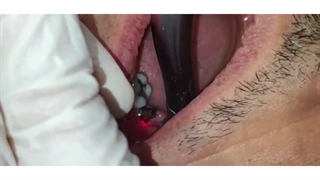 کاربرد لیزر اربیوم برای uncovering ایمپلنت دندان | کلینیک دکتر پورشاهی