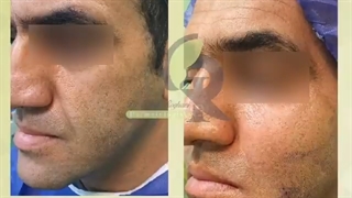 تزریق چربی صورت