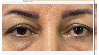 نتیجه جراحی بلفاروپلاستی چهار پلک