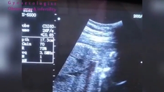 فیلم سونوگرافی برای اولین بار