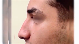 جراحی زیبایی بینی مردانه و کاملا طبیعی | دکتر باستانی نژاد