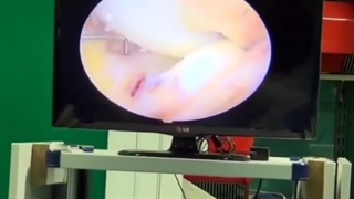 عمل جراحی درمان پارگی منیسک