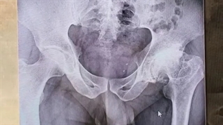 جراحی تعویض مفصل لگن