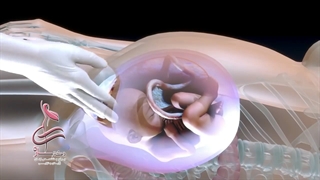 زایمان  سزارین