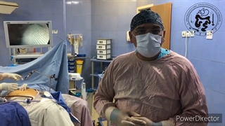 اسلیو معده و درمان ریفلاکس