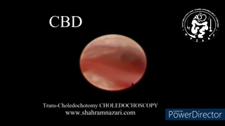 کلدوکوسکوپی از طریق مجرای اصلی صفرا(کلدوک)