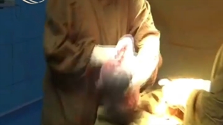 زایمان سزارین