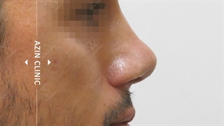 اصلاح فرم بینی